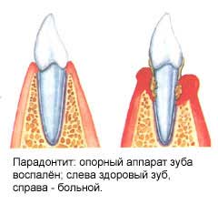 Лечим пародонтоз